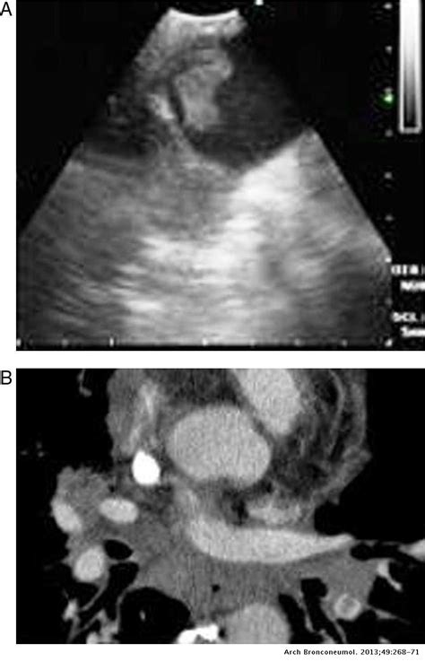 Diagnostic Imaging Of Pulmonary Embolism Using Endobronchial Ultrasound Archivos De