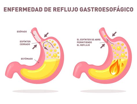 Reflujo ácido Y Reflujo Gastroesofágico ¿son Lo Mismo