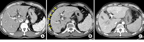Figure 2 From Pancreaticoduodenectomy With Combined Hepatic Artery And