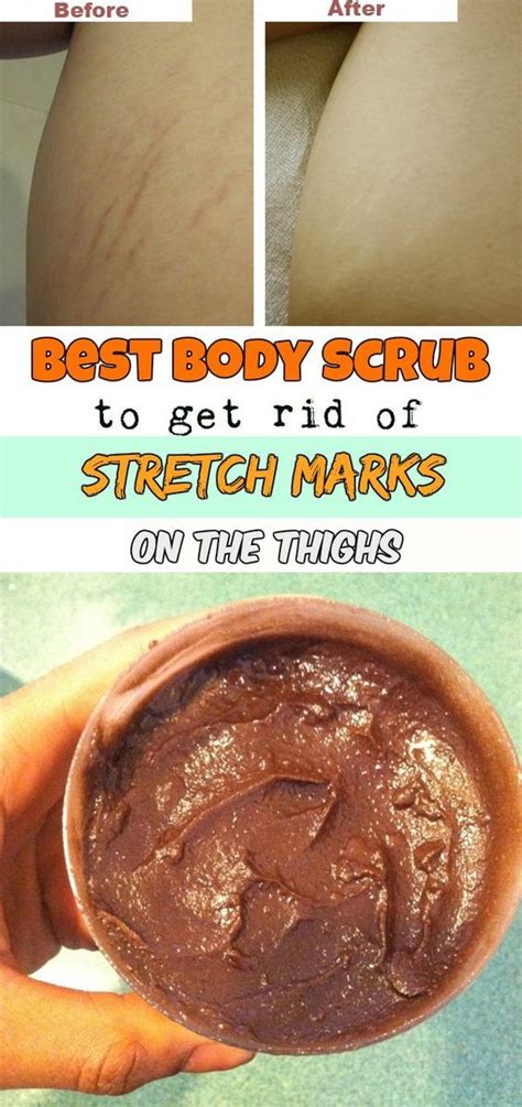 Hop in the shower, rub on some shaving cream, grab a disposable razor, and have at it. Best body scrub to get rid of stretch marks on the thighs ...