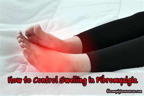 How To Control Swelling In Fibromyalgia Fibromyalgia Resources
