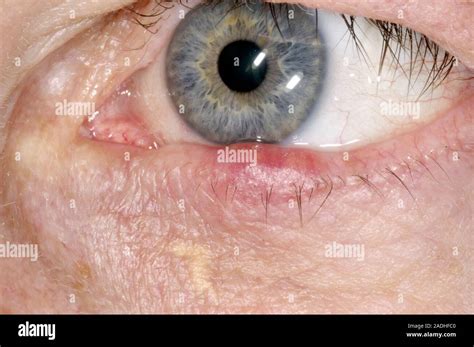 Model Released Eye Cyst On The Lower Eyelid Of A 58 Year Old Man This