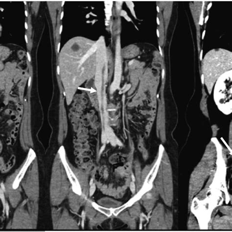 Preoperative Contrast Enhanced Computed Tomography Findings Download