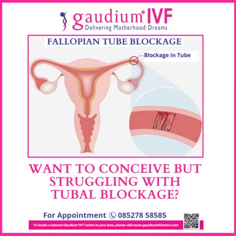Fallopian Tubal Blockage Damage Or Blockage Block Fallopian Tubes