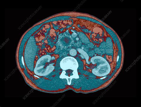 Pancreatic Cancer Ct Scan Stock Image C0294651 Science Photo