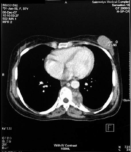Ct Scan Of Chest Revealed Well Defined Heterogenous Left Paraspinal