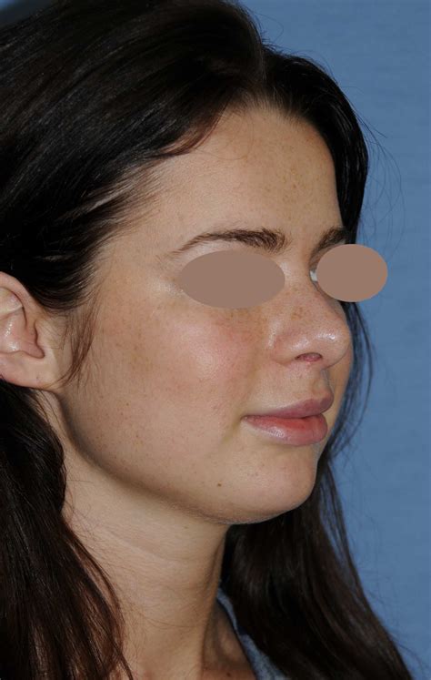 Rhinoplasty Before And After Photos Seattle Bellevue