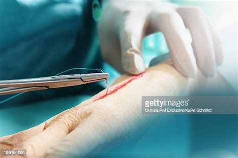 Incision Photos And Premium High Res Pictures Getty Images