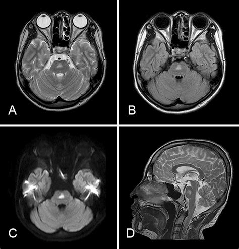 Figure2mri Of The Brain In Case 2 A T2 Weighted Image B Flair