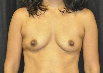 Before After Breast Augmentation Dr Smith