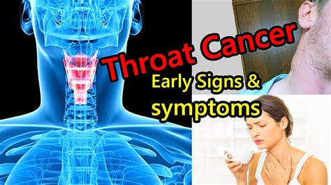 What Are The Symptoms Of Throat Cancer Throat Cancer