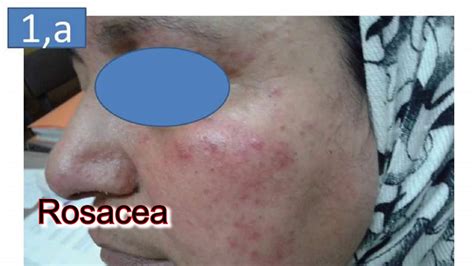Differential Diagnosis Between Rosacea And Lmdf By Dr Mohamed