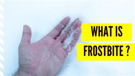 What Is Frostbite How To Treat Frostbite Youtube