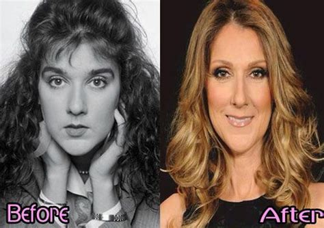 Celine Dion Plastic Surgery Before And After In Celebrity Plastic Surgery Plastic