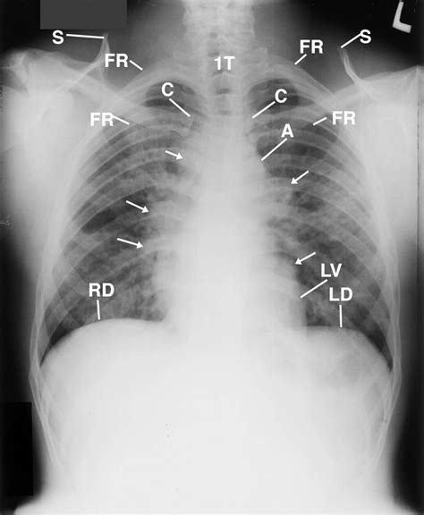 Lungs Lungs Lymph Nodes