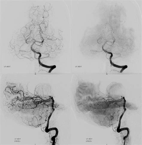 Angiography — Thalamic Hemorrhage Spot Sign