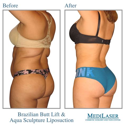 Check Out This Incredible Brazilian Butt Lift Performed By Dr G