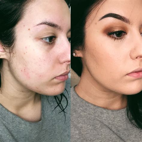 Cover Your Acne Completely With This Tip Acne Makeup Tutorial Acne