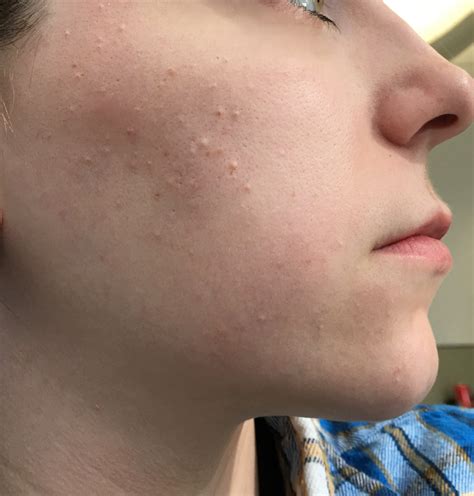 Small Skin Colored Bumps On Cheeks Beauty Insider Community