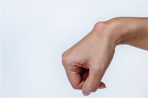Ganglion Cyst Greater Chesapeake Hand Specialists