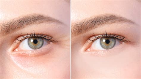 How To Get Rid Of Under Eye Wrinkles Free Treatment Tips Perfect