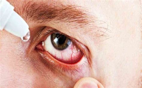 Health Tips Burning Sensation Due To Eye Flu You Can Also Adopt These Home Remedies Lifestyle
