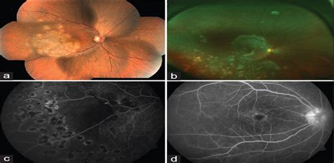 Imaging In Tuberculosis Associated Uveitis Indian Journal Of