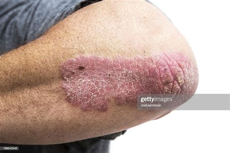 Psoriasis On A Mid Age Mans Elbow High Res Stock Photo Getty Images