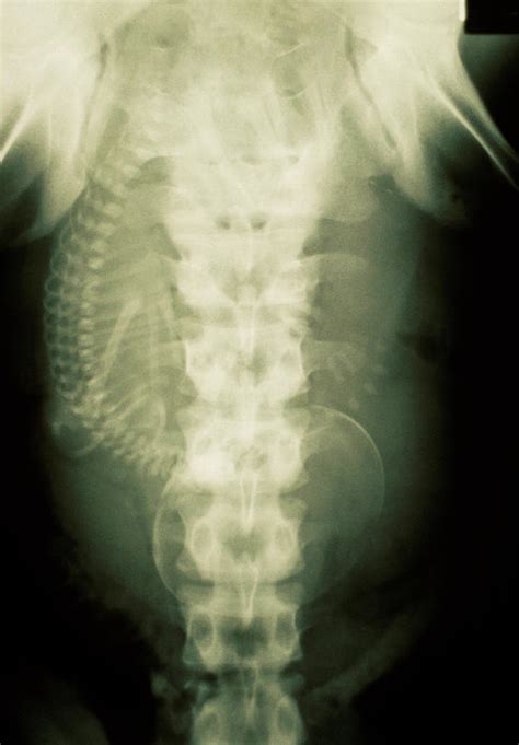 X Ray Of Abdomen Of A Pregnant Woman Photograph By Dr Vic Bradbury