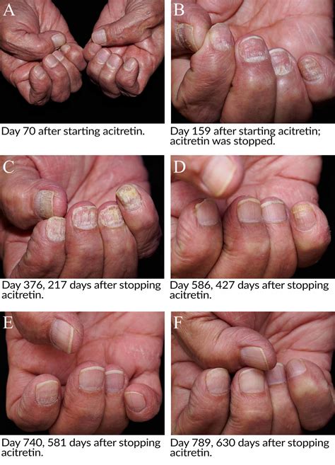 Cureus Trachyonychia Secondary To Acitretin Usage