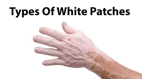 Although this is a harmless condition, but treatments are required and sometimes treatment can be difficult too. Types Of White Patches/Leucoderma - YouTube