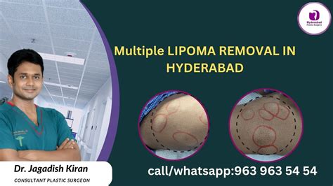 Lipoma Removal Surgery Cost In Hyderabad Multiple Lipoma Removal