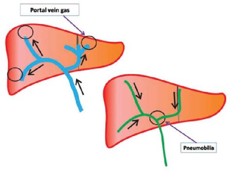 Location Of Pneumobilia And Portal Vein Gas In The Liver Based On The