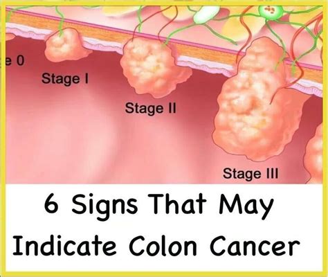 Symptoms, treatment & life expectancy of stage 3 colon cancer. Stage 4 Colon Cancer Survival Stories - Cancer News Update