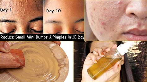 Best Hacks To Treat Tiny Bumps Pimples Whiteheads On Your Forehead
