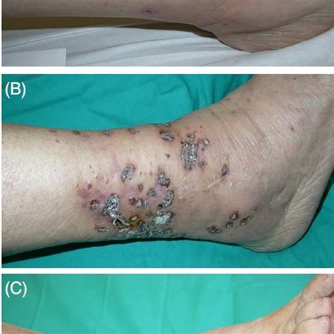 Clinical Image Distant Malignant Melanoma Mm Metastasis An