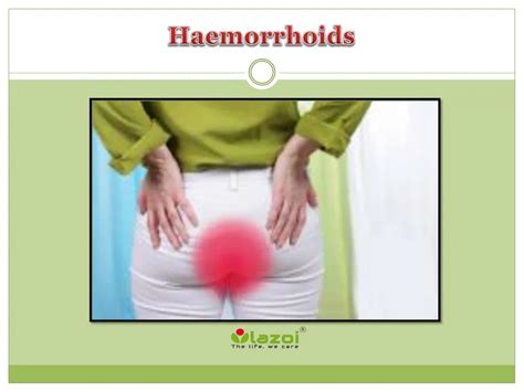 Ppt Haemorrhoids Symptoms Causes Diagnosis And Treatment Powerpoint Presentation Id7667276