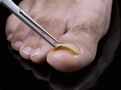 Toenail Fungus Relief In Los Angeles Toenail Fungus Treatment Center