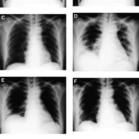 Serial Chest Radiographs Of A 40 Year Old Male Patient With Severe