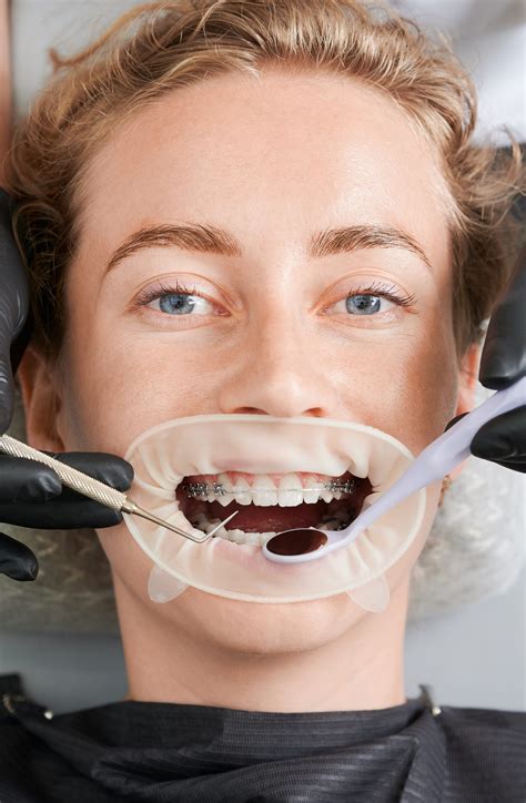 What Dental Insurance Covers Braces? - Best Dental
