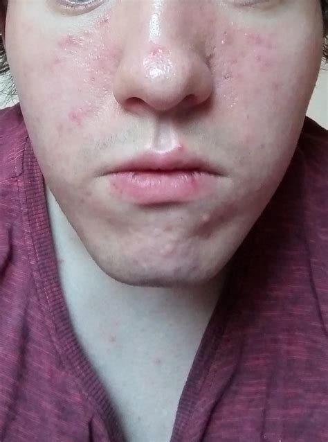 Skin Concerns Having Trouble With Reddened And Also Sometimes Very