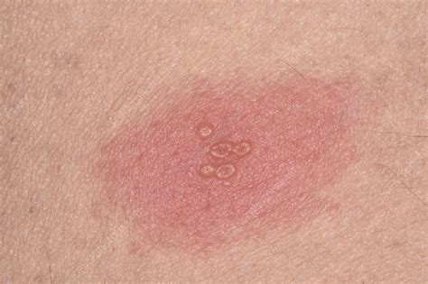 Shingles Rash Stock Image C0473051 Science Photo Library