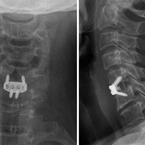 Anterior Cervical Discectomy And Fusion Using Polyetheretherketone Cage