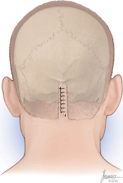 Surgical Treatment Of Occipital Migraine Headaches Site Iv Plastic