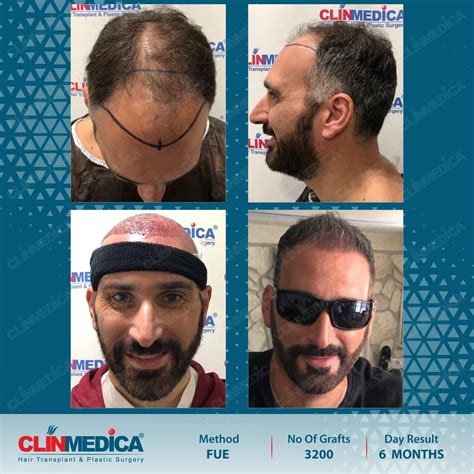 The Definitive Guide To Fue Hair Transplant Turkey Clinmedica
