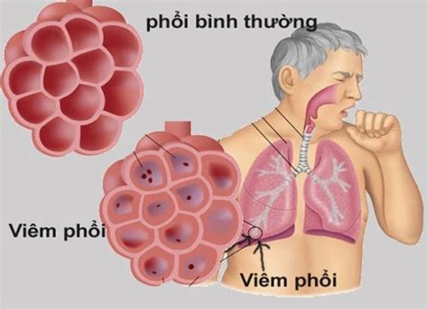 Nồng độ o2 trong máu giảm nhiều. Viêm phổi là gì?