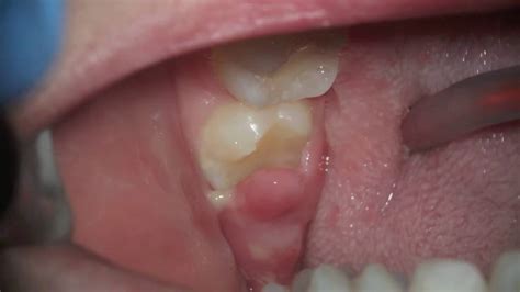 Swollen Gum Around One Tooth But No Pain Change Comin