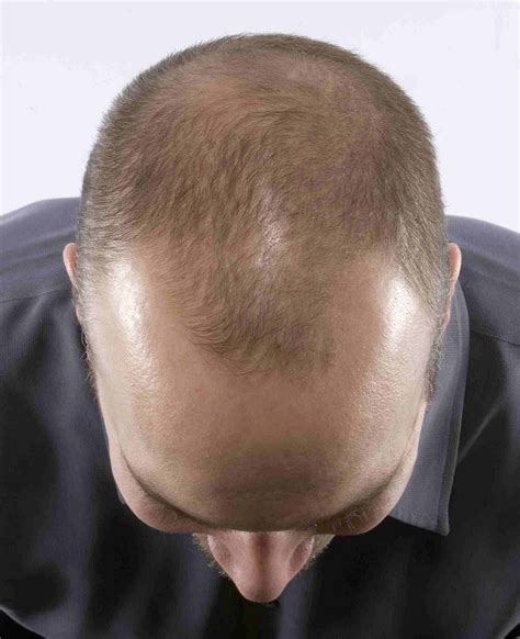 Hair Loss Expert Why Men Are Balding So Early