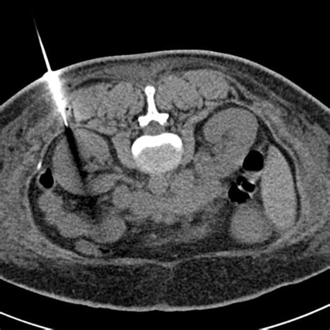 Ct Guided Renal Biopsy Radiology Case Renal