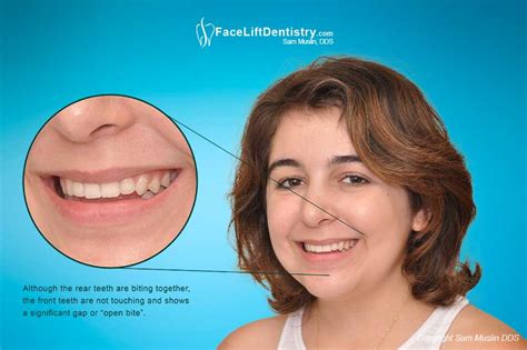 How To Fix An Overbite Naturally At Home Reverasite
